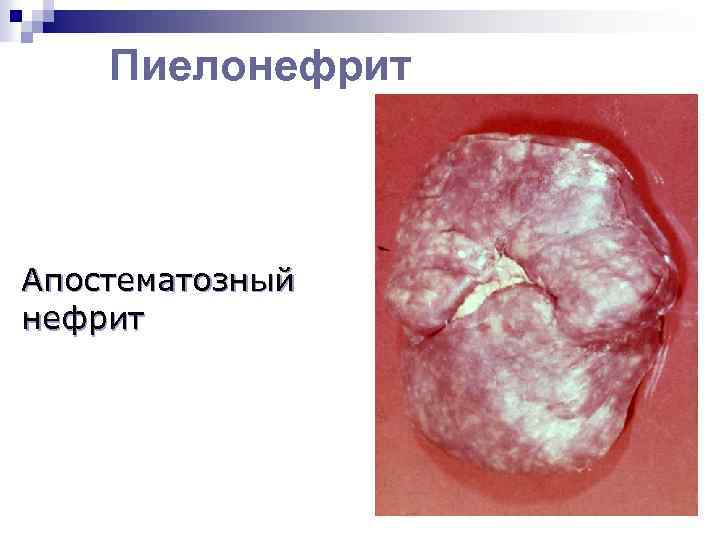 Пиелонефрит Апостематозный нефрит 
