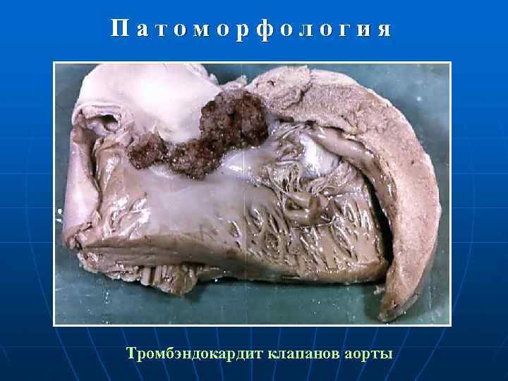 Патоморфология Тромбэндокардит клапанов аорты 