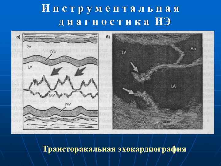 Инструментальная д и а г н о с т и к а ИЭ Трансторакальная