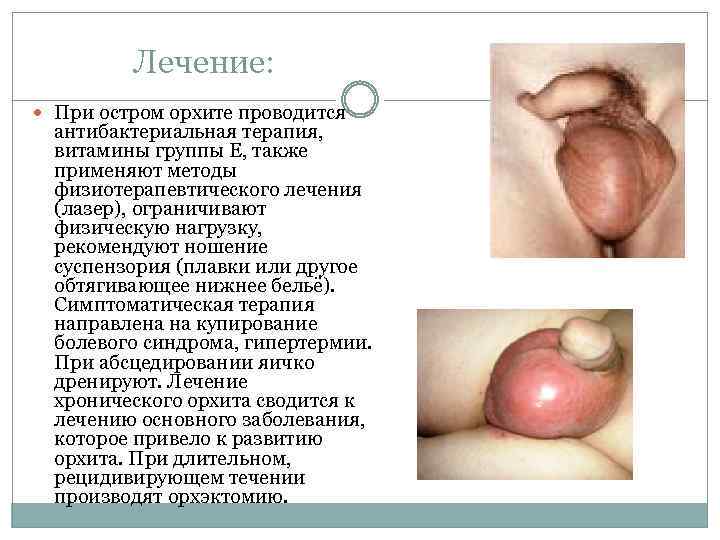 Лечение: При остром орхите проводится антибактериальная терапия, витамины группы E, также применяют методы физиотерапевтического