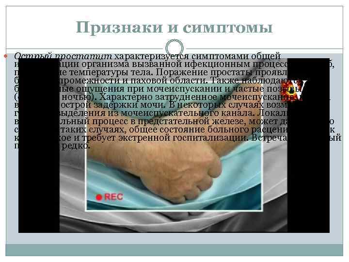 Признаки и симптомы Острый простатит характеризуется симптомами общей интоксикации организма вызванной ифекционным процессом: озноб,
