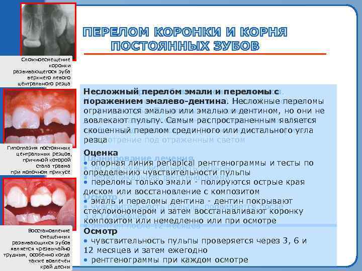 Сложноесмещение коронки развивающегося зуба верхнего левого центрального резца Гипоплазия постоянных центральных резцов, причиной которой