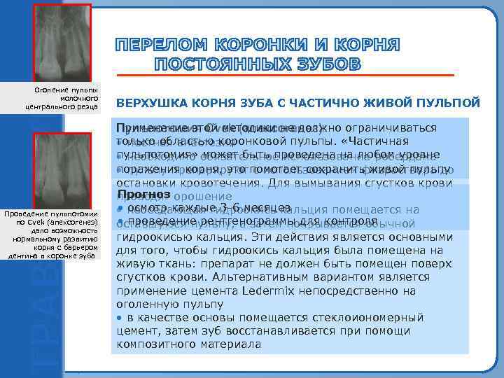 Оголение пульпы молочного центрального резца ВЕРХУШКА КОРНЯ ЗУБА С ЧАСТИЧНО ЖИВОЙ ПУЛЬПОЙ Применение этой