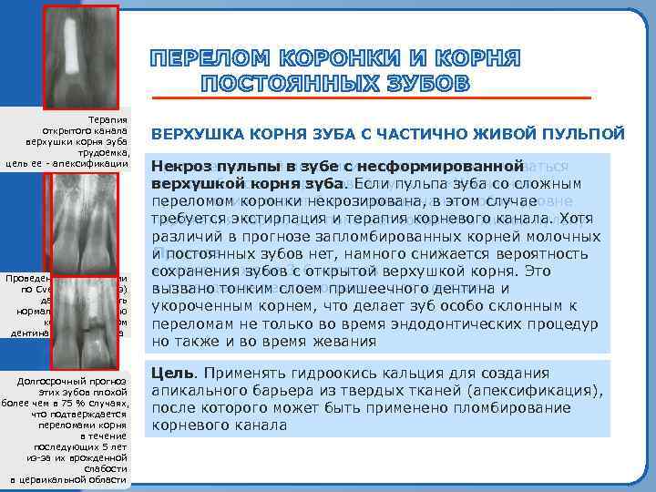 Оголение. Терапия пульпы молочного открытого канала центрального резца верхушки корня зуба трудоемка, цель ее