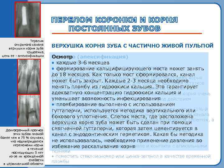 Терапия открытого канала верхушки корня зуба трудоемка, цель ее ‑ апексификации ВЕРХУШКА КОРНЯ ЗУБА