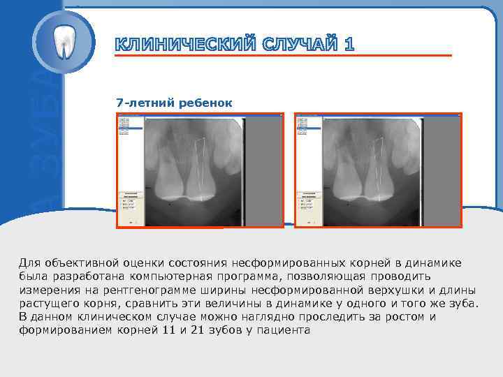 7 -летний ребенок Пробный текст Для объективной оценки состояния несформированных корней в динамике была