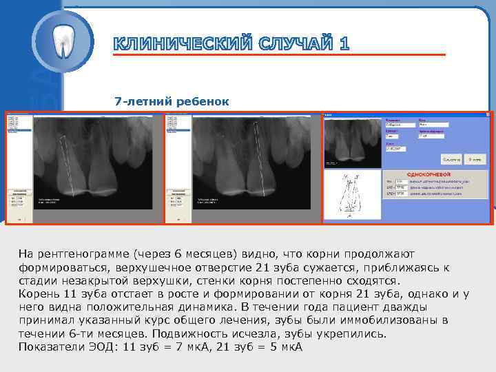 7 -летний ребенок Пробный текст На рентгенограмме (через 6 месяцев) видно, что корни продолжают