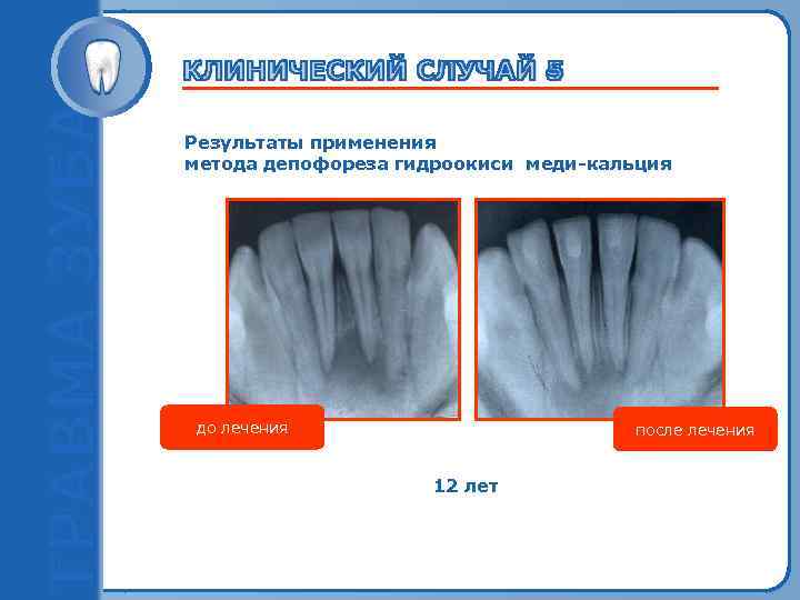 Результаты применения метода депофореза гидроокиси меди-кальция Пробный текст до лечения после лечения 12 лет