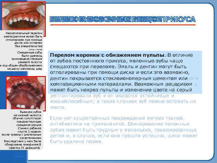 Макроскопическое смещение Незначительный перелом всех верхних эмали/дентина может быть передних зубов отполирован при помощи