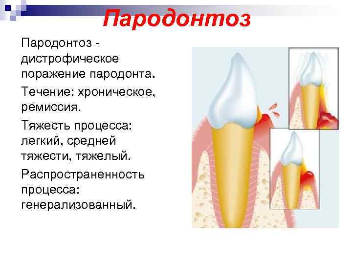 Пародонтоз лечение