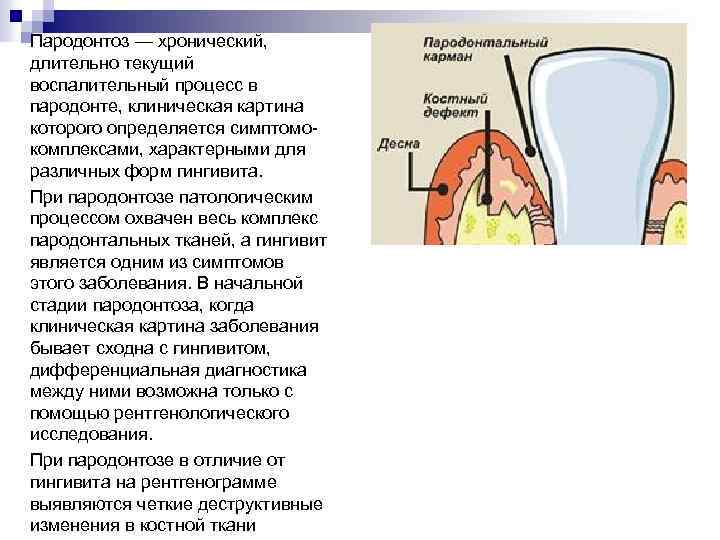 Пародонтоз — хронический, длительно текущий воспалительный процесс в пародонте, клиническая картина которого определяется симптомокомплексами,