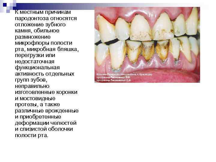 К местным причинам пародонтоза относятся отложение зубного камня, обильное размножение микрофлоры полости рта, микробная