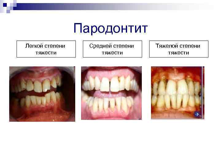 Пародонтит Легкой степени тяжести Средней степени тяжести Тяжелой степени тяжести 