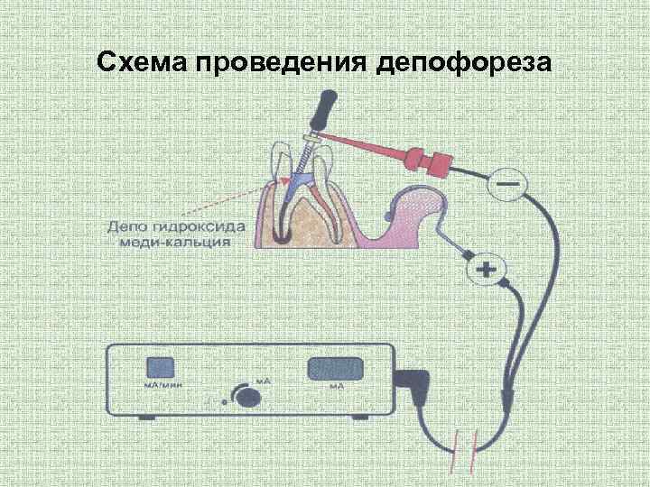 Схема проведения депофореза 