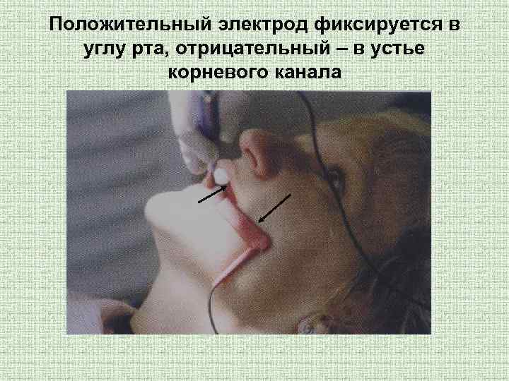 Положительный электрод фиксируется в углу рта, отрицательный – в устье корневого канала 