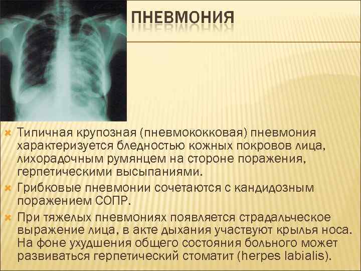  Типичная крупозная (пневмококковая) пневмония характеризуется бледностью кожных покровов лица, лихорадочным румянцем на стороне