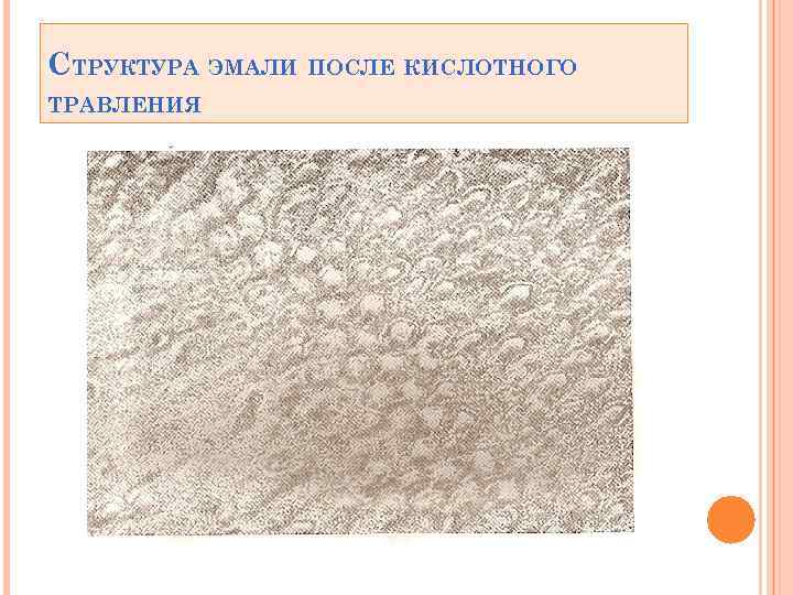 СТРУКТУРА ЭМАЛИ ПОСЛЕ КИСЛОТНОГО ТРАВЛЕНИЯ 