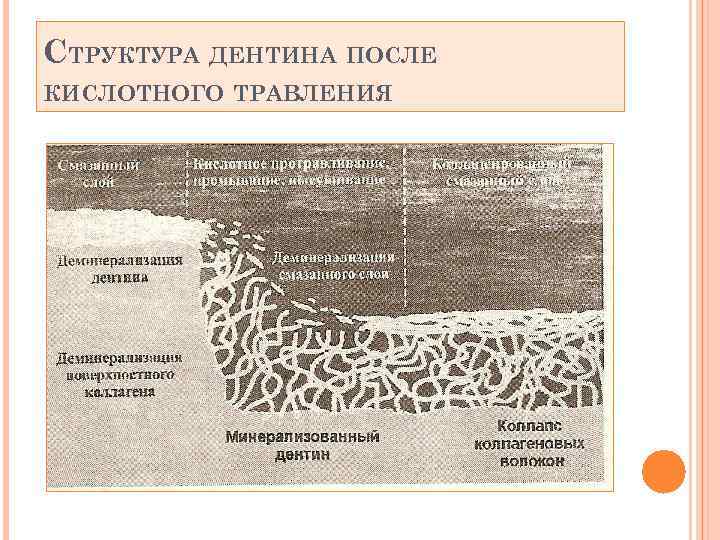 СТРУКТУРА ДЕНТИНА ПОСЛЕ КИСЛОТНОГО ТРАВЛЕНИЯ 
