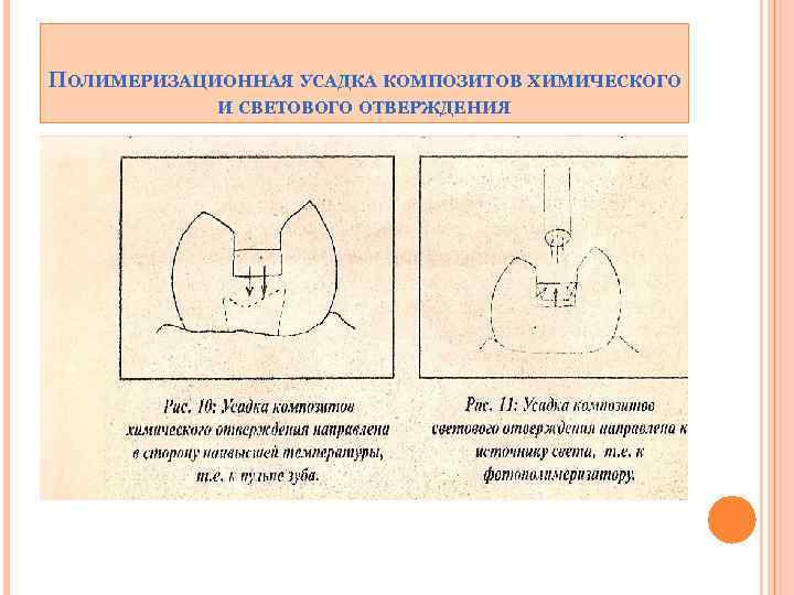 ПОЛИМЕРИЗАЦИОННАЯ УСАДКА КОМПОЗИТОВ ХИМИЧЕСКОГО И СВЕТОВОГО ОТВЕРЖДЕНИЯ 