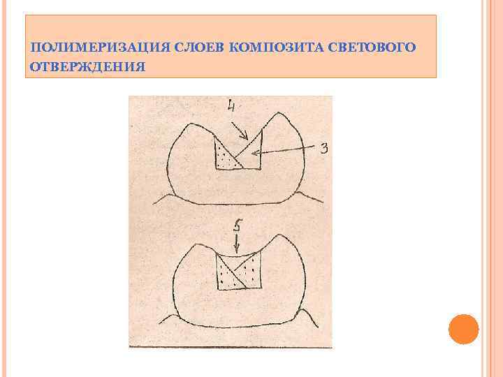 ПОЛИМЕРИЗАЦИЯ СЛОЕВ КОМПОЗИТА СВЕТОВОГО ОТВЕРЖДЕНИЯ 