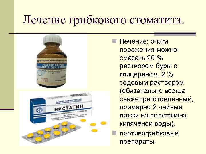 Лечение грибкового стоматита. n Лечение: очаги поражения можно смазать 20 % раствором буры с