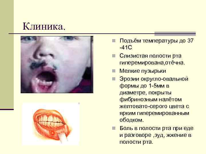 Клиника. n Подъём температуры до 37 n n -41 С Слизистая полости рта гиперемирована,