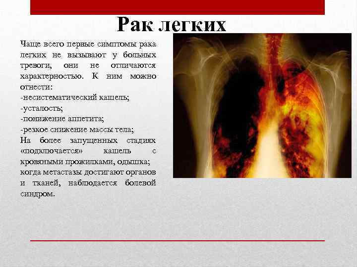 Рак легких Чаще всего первые симптомы рака легких не вызывают у больных тревоги, они