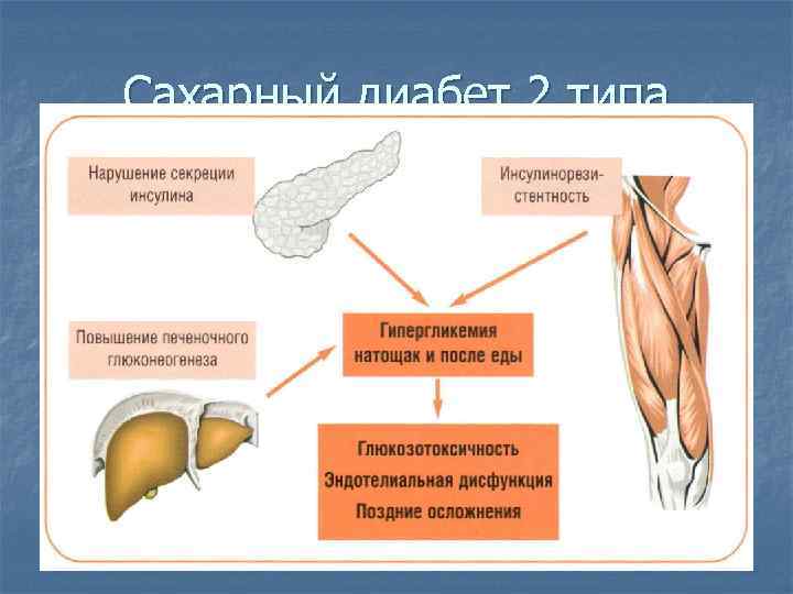 Сахарный диабет 2 типа 