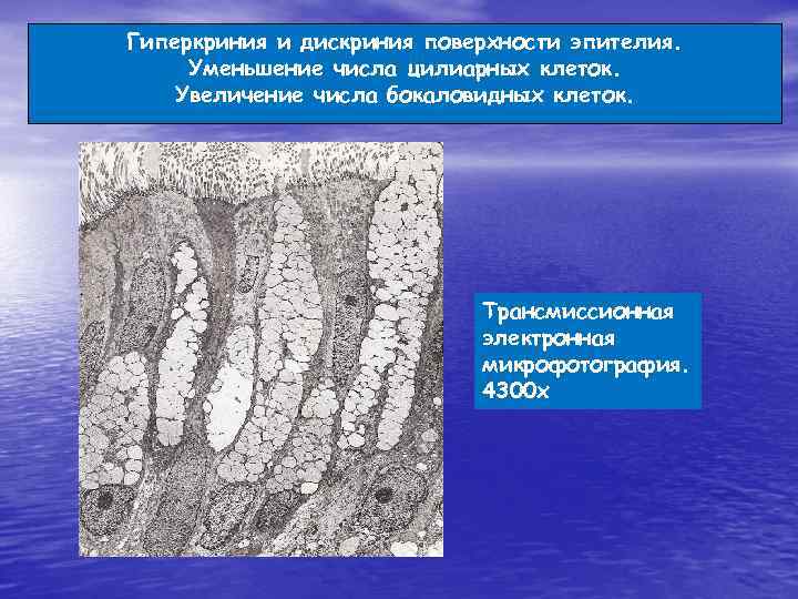 Гиперкриния и дискриния поверхности эпителия. Уменьшение числа цилиарных клеток. Увеличение числа бокаловидных клеток. Трансмиссионная