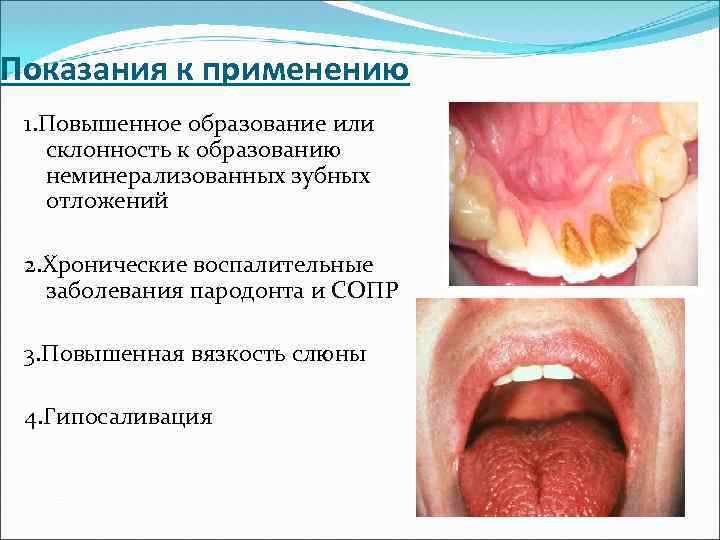 Показания к применению 1. Повышенное образование или склонность к образованию неминерализованных зубных отложений 2.