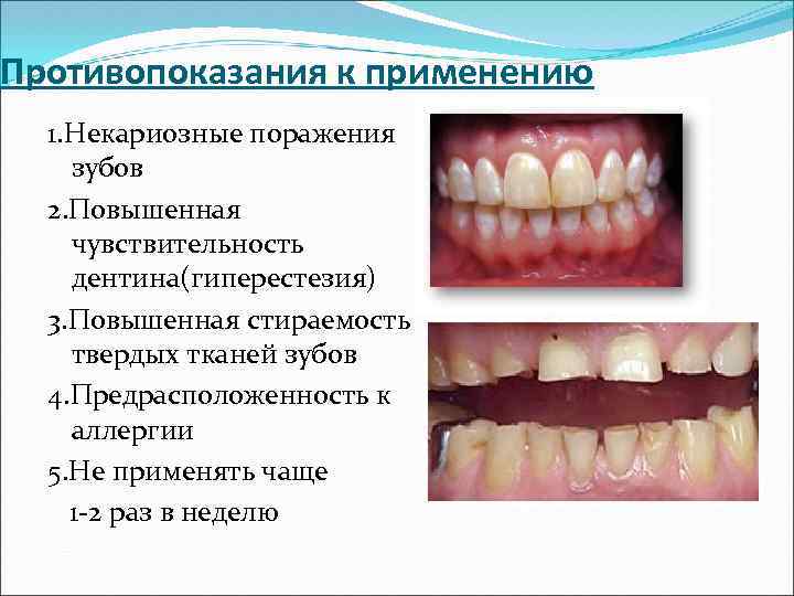 Противопоказания к применению 1. Некариозные поражения зубов 2. Повышенная чувствительность дентина(гиперестезия) 3. Повышенная стираемость