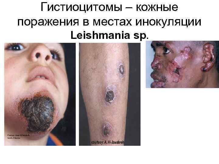 Гистиоцитомы – кожные поражения в местах инокуляции Leishmania sp. 