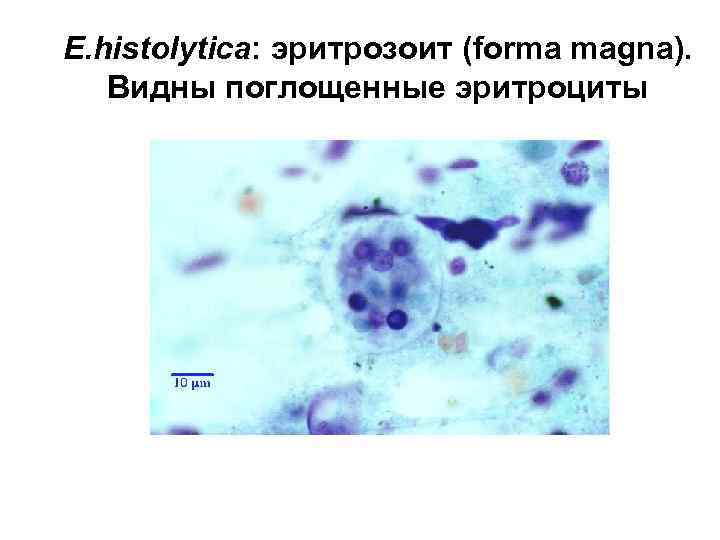 E. histolytica: эритрозоит (forma magna). Видны поглощенные эритроциты 