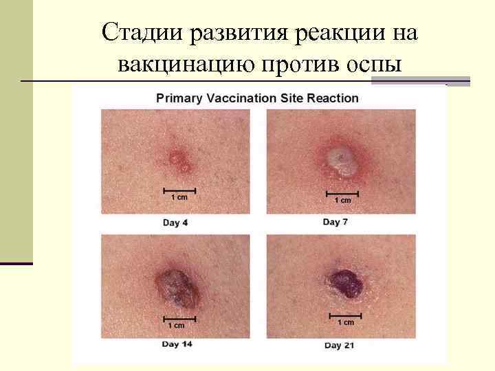 Стадии развития реакции на вакцинацию против оспы 