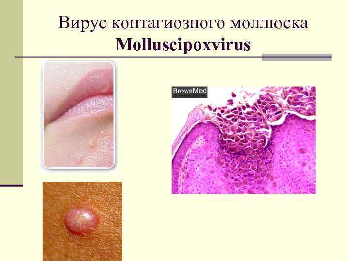 Вирус контагиозного моллюска Molluscipoxvirus 