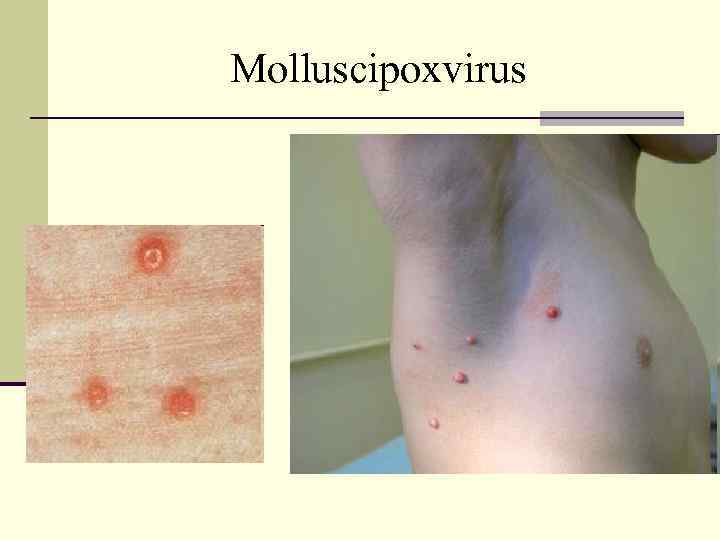 Molluscipoxvirus 