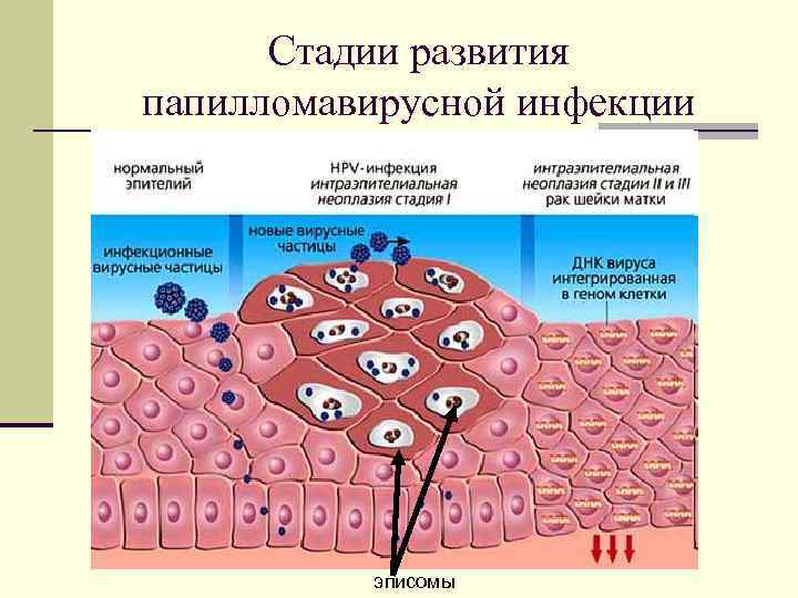 Стадии развития папилломавирусной инфекции эписомы 