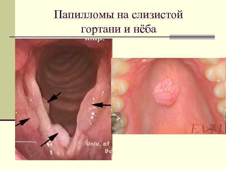 Папилломы на слизистой гортани и нёба 