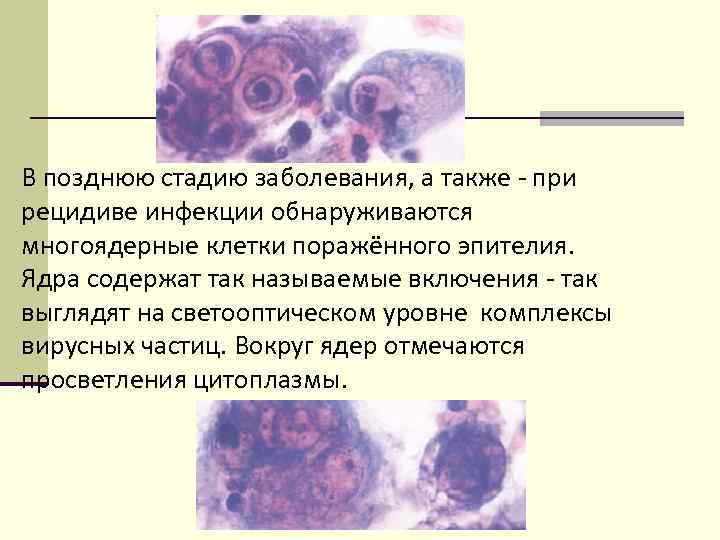 В позднюю стадию заболевания, а также - при рецидиве инфекции обнаруживаются многоядерные клетки поражённого