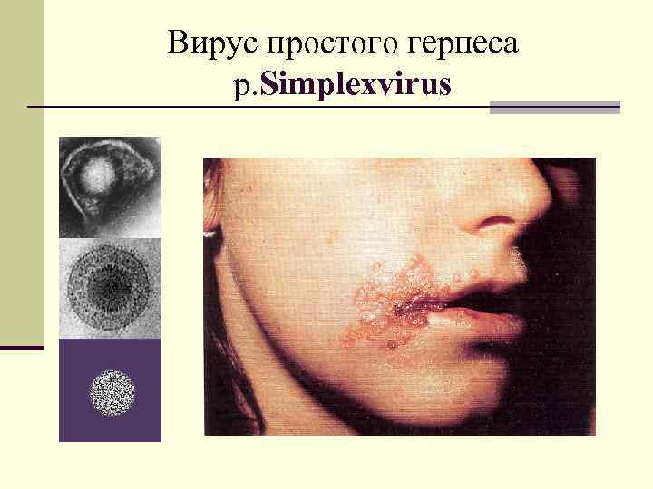 Вирус простого герпеса р. Simplexvirus 