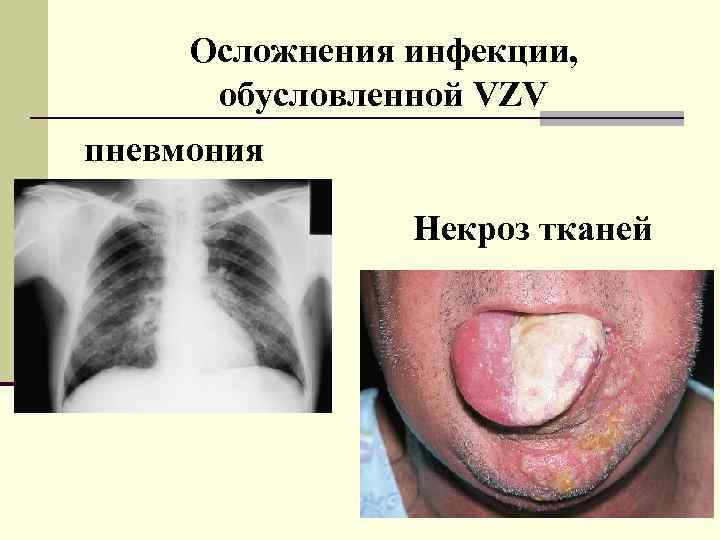 Осложнения инфекции, обусловленной VZV пневмония Некроз тканей 