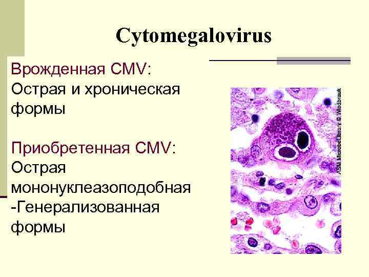 Сytomegalovirus Врожденная CMV: Острая и хроническая формы Приобретенная CMV: Острая мононуклеазоподобная -Генерализованная формы 