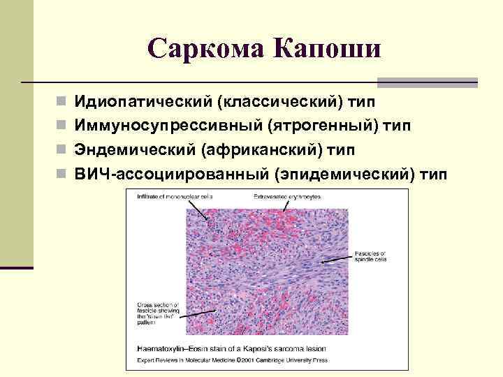 Саркома Капоши n Идиопатический (классический) тип n Иммуносупрессивный (ятрогенный) тип n Эндемический (африканский) тип