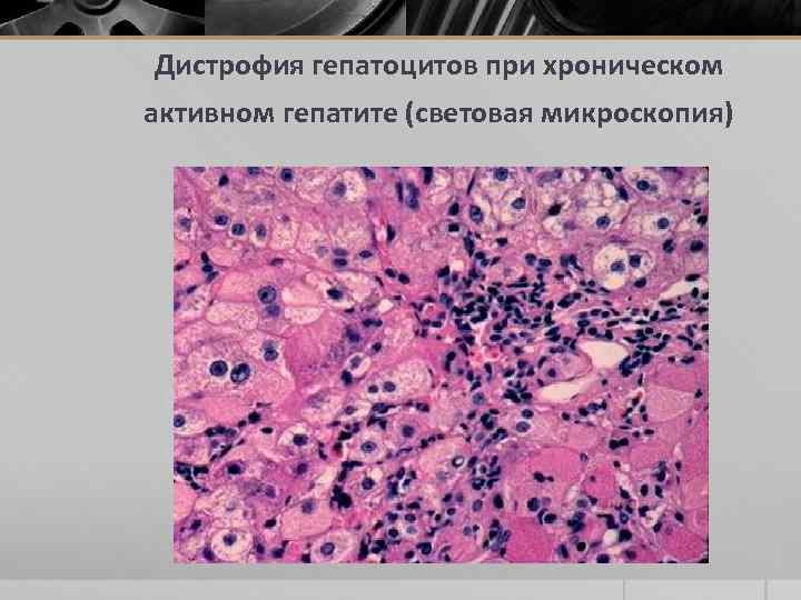 Дистрофия гепатоцитов при хроническом активном гепатите (световая микроскопия) 