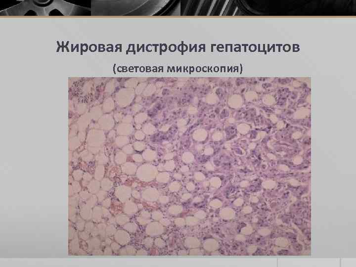 Жировая дистрофия гепатоцитов (световая микроскопия) 