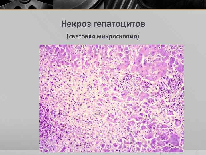 Некроз гепатоцитов (световая микроскопия) 