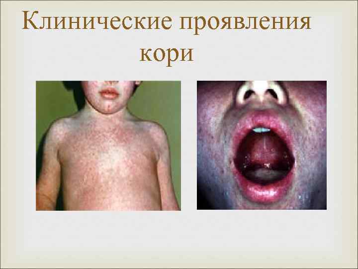 Клинические проявления кори 