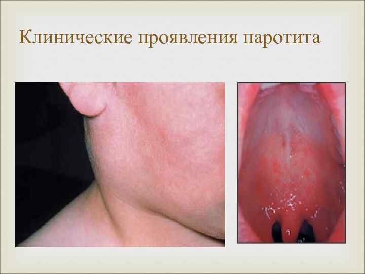Клинические проявления паротита 