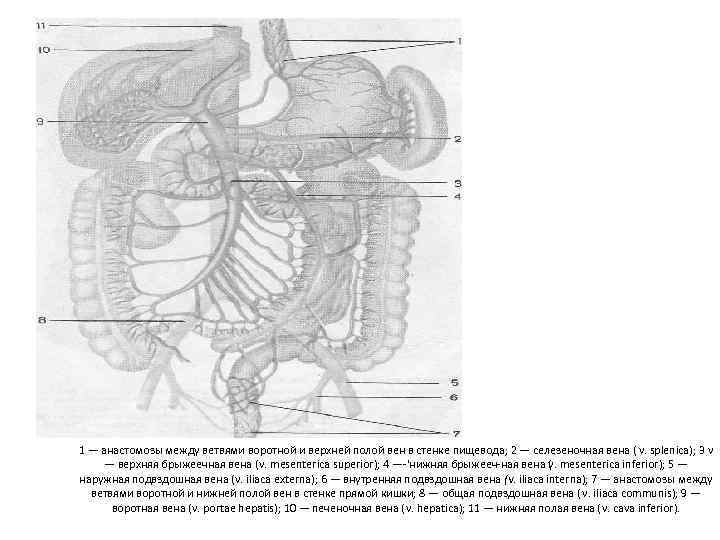 1 — анастомозы между ветвями воротной и верхней полой вен в стенке пищевода; 2