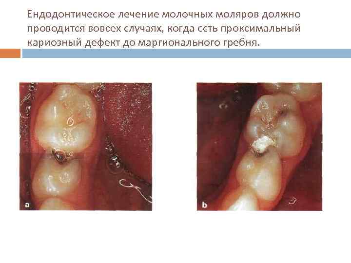 Ендодонтическое лечение молочных моляров должно проводится вовсех случаях, когда єсть проксимальный кариозный дефект до